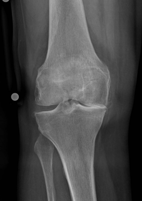 Röntgenbild vor OP von vorn